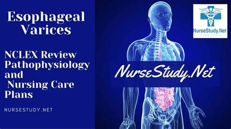 medical <strong>&</strong> surgical nursing MCQ 6. . A nurse is caring for a client who has esophageal varices and is hypotensive